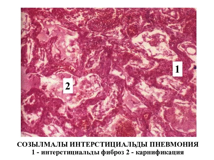 СОЗЫЛМАЛЫ ИНТЕРСТИЦИАЛЬДЫ ПНЕВМОНИЯ 1 2 1 - интерстициальды фиброз 2 - карнификация