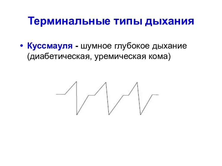 Терминальные типы дыхания Куссмауля - шумное глубокое дыхание (диабетическая, уремическая кома)