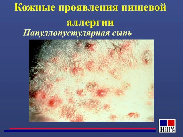 Папуллопустулярная сыпь Кожные проявления пищевой аллергии