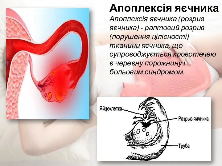 Апоплексія яєчника Апоплексія яєчника (розрив яєчника) - раптовий розрив (порушення