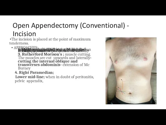 Open Appendectomy (Conventional) - Incision The incision is placed at