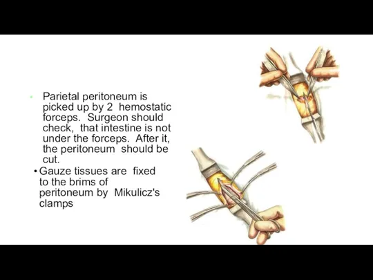 Parietal peritoneum is picked up by 2 hemostatic forceps. Surgeon