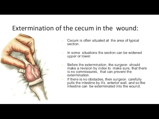 Extermination of the cecum in the wound: Cecum is often