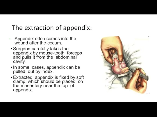 The extraction of appendix: Appendix often comes into the wound