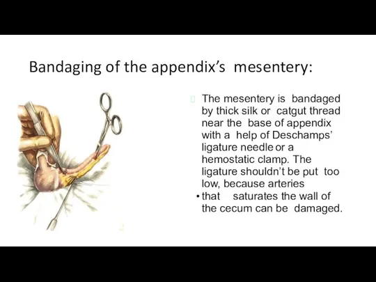 Bandaging of the appendix’s mesentery: The mesentery is bandaged by