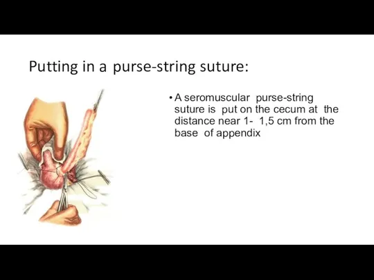 Putting in a purse-string suture: A seromuscular purse-string suture is