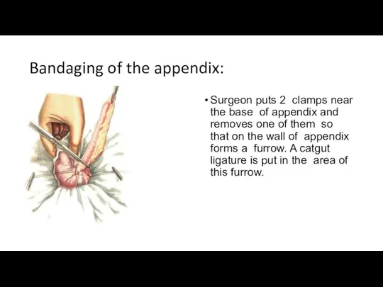 Bandaging of the appendix: Surgeon puts 2 clamps near the