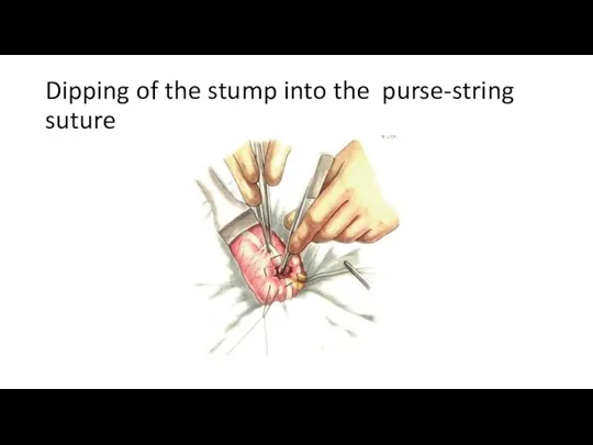 Dipping of the stump into the purse-string suture