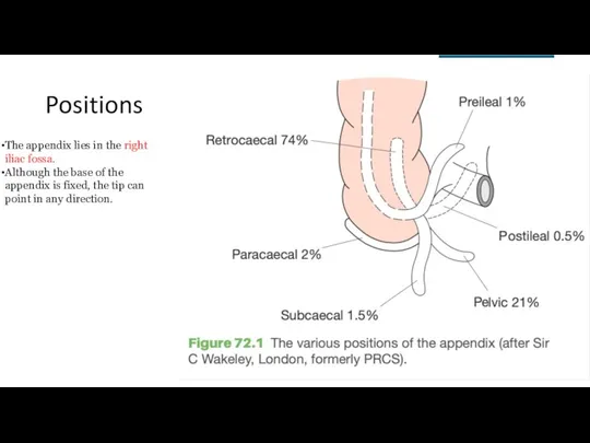 Positions The appendix lies in the right iliac fossa. Although