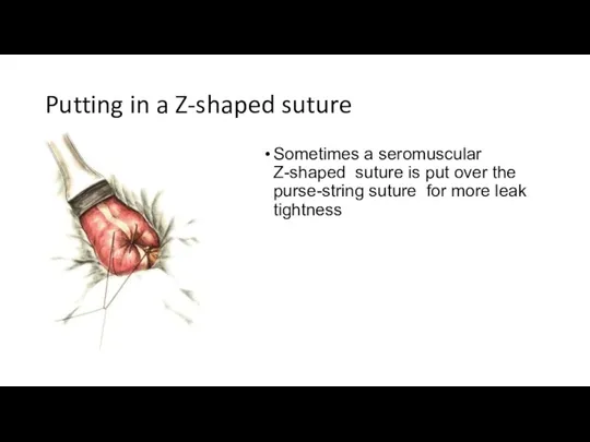 Putting in a Z-shaped suture Sometimes a seromuscular Z-shaped suture