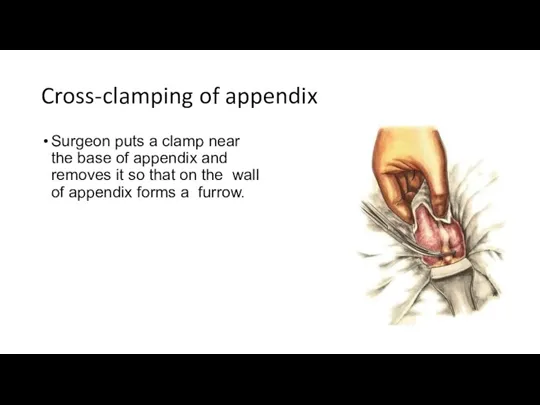 Cross-clamping of appendix Surgeon puts a clamp near the base