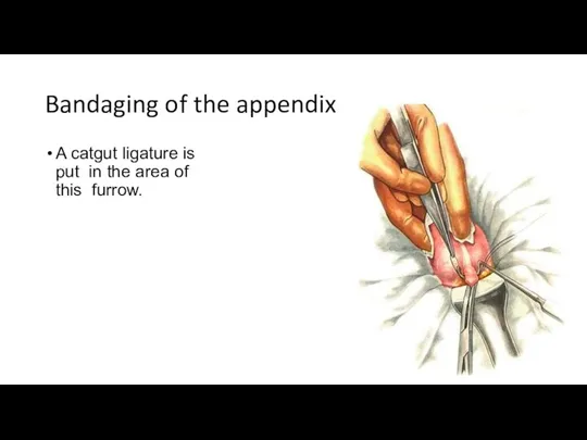 Bandaging of the appendix A catgut ligature is put in the area of this furrow.