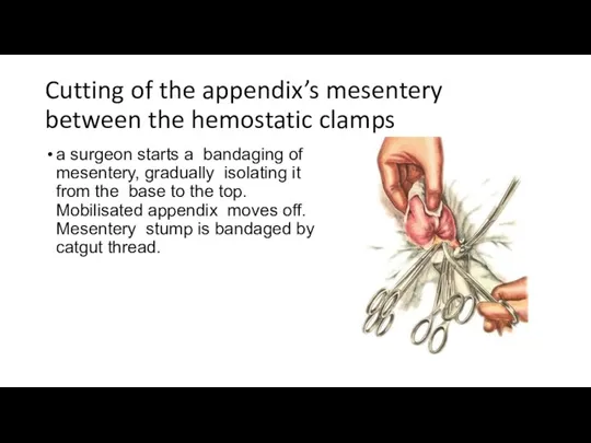 Cutting of the appendix’s mesentery between the hemostatic clamps a