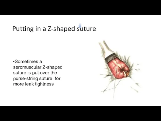 Putting in a Z-shaped suture Sometimes a seromuscular Z-shaped suture