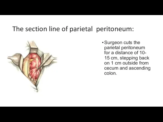 The section line of parietal peritoneum: Surgeon cuts the parietal