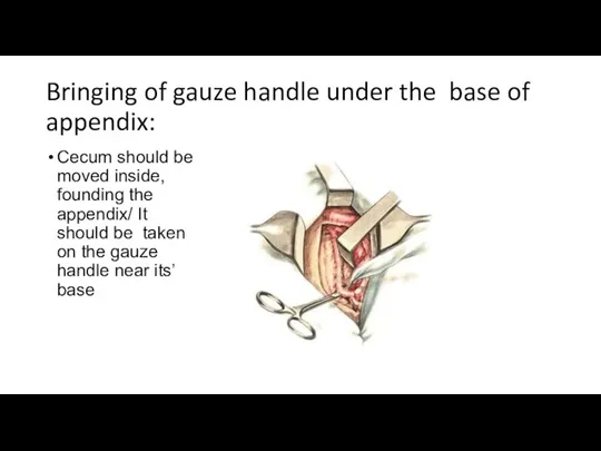 Bringing of gauze handle under the base of appendix: Cecum