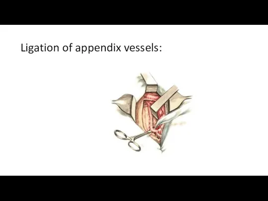 Ligation of appendix vessels: