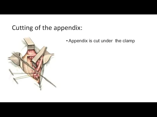 Cutting of the appendix: Appendix is cut under the clamp