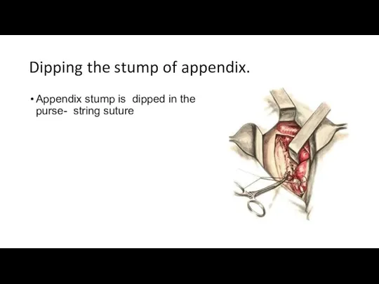 Dipping the stump of appendix. Appendix stump is dipped in the purse- string suture