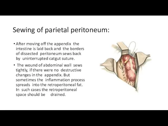 Sewing of parietal peritoneum: After moving off the appendix the