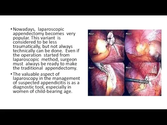 Nowadays, laparoscopic appendectomy becomes very popular. This variant is considered