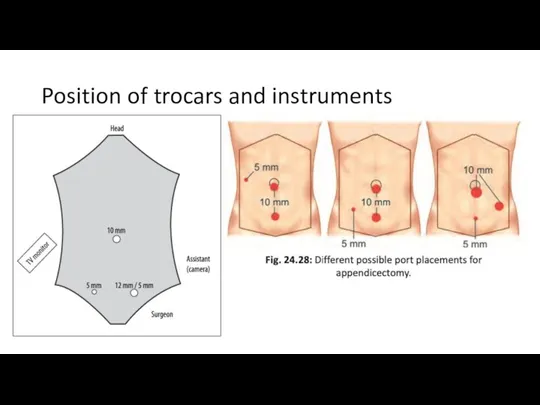 Position of trocars and instruments