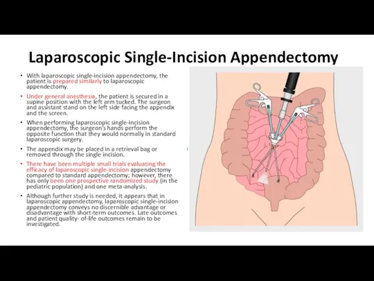 Laparoscopic Single-Incision Appendectomy With laparoscopic single-incision appendectomy, the patient is