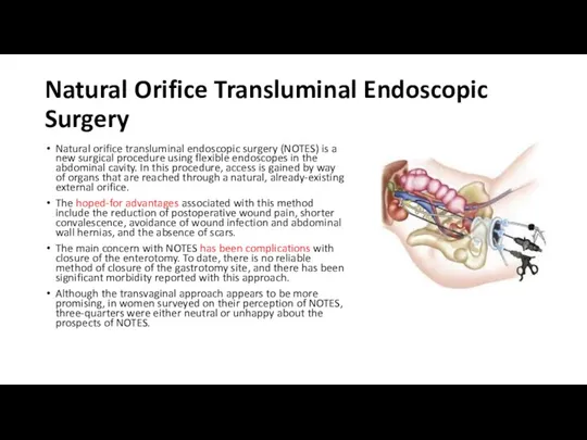 Natural Orifice Transluminal Endoscopic Surgery Natural orifice transluminal endoscopic surgery