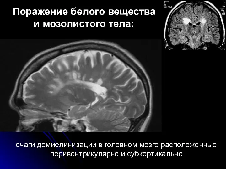 Поражение белого вещества и мозолистого тела: очаги демиелинизации в головном мозге расположенные перивентрикулярно и субкортикально