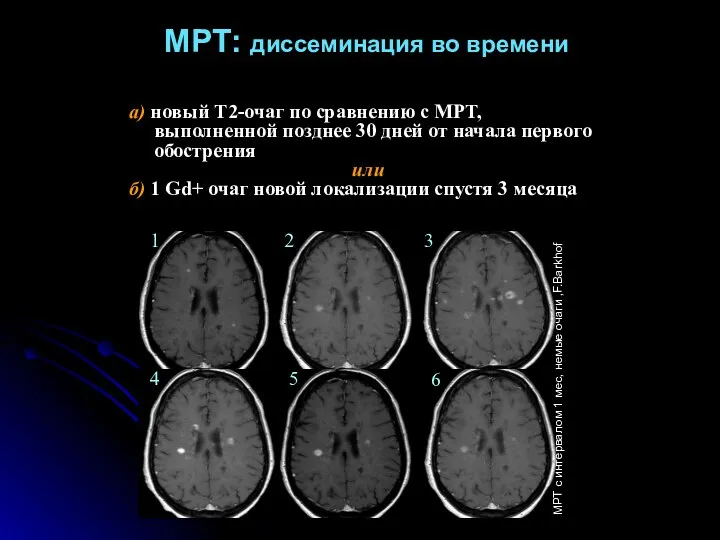 МРТ: диссеминация во времени а) новый Т2-очаг по сравнению с