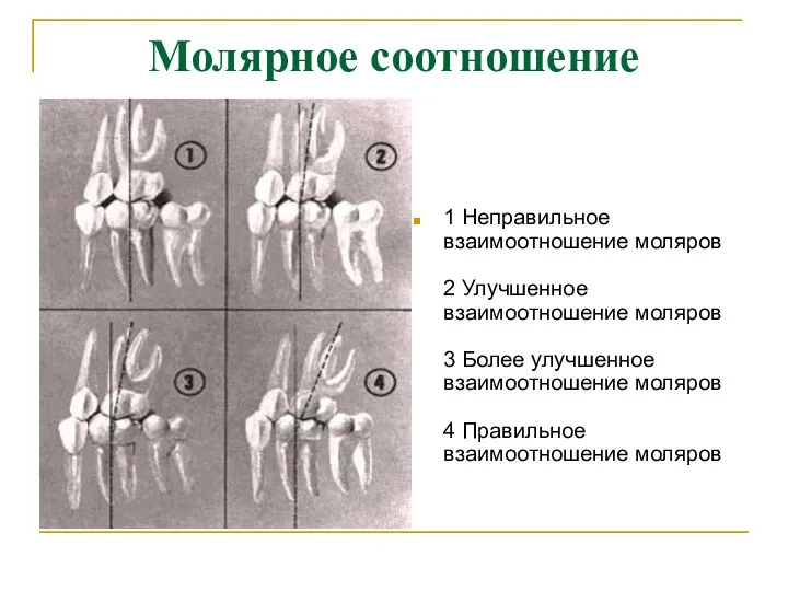 Молярное соотношение 1 Неправильное взаимоотношение моляров 2 Улучшенное взаимоотношение моляров