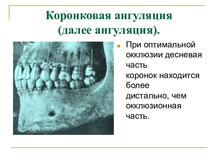 Коронковая ангуляция (далее ангуляция). При оптимальной окклюзии десневая часть коронок находится более дистально, чем окклюзионная часть.