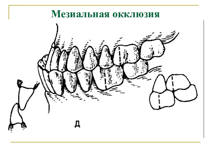 Мезиальная окклюзия