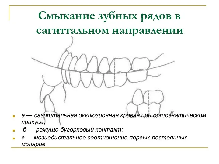 Смыкание зубных рядов в сагиттальном направлении а — сагиттальная окклюзионная