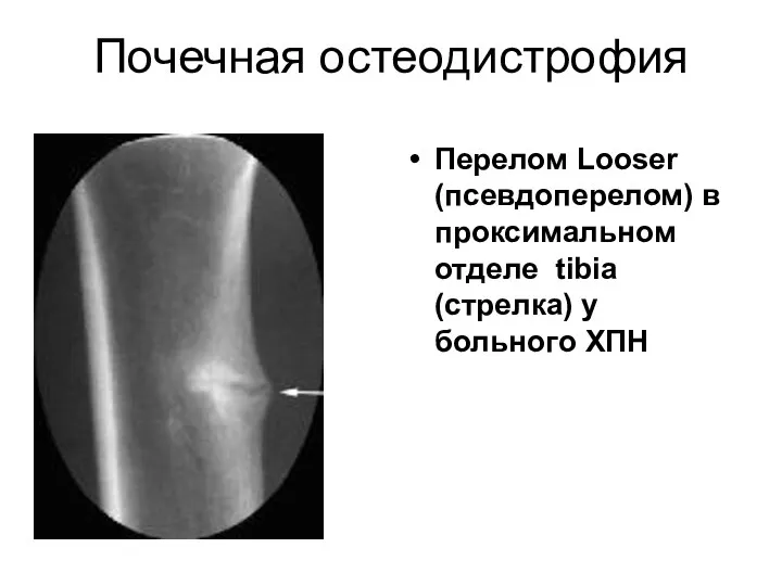 Почечная остеодистрофия Перелом Looser (псевдоперелом) в проксимальном отделе tibia (стрелка) у больного ХПН