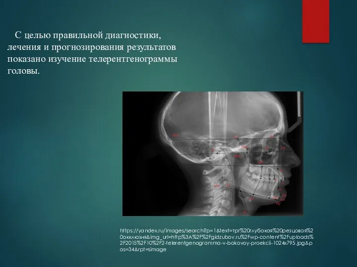 Телерентгенография С целью правильной диагностики, лечения и прогнозирования результатов показано изучение телерентгенограммы головы. https://yandex.ru/images/search?p=1&text=трг%20глубокая%20резцовая%20окклюзия&img_url=http%3A%2F%2Fgidzubov.ru%2Fwp-content%2Fuploads%2F2015%2F10%2F2-telerentgenogramma-v-bokovoy-proekcii-1024x795.jpg&pos=34&rpt=simage