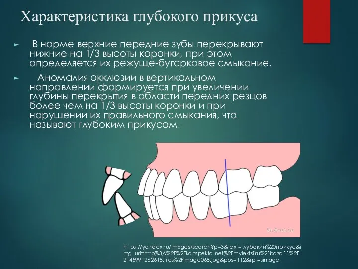 Характеристика глубокого прикуса В норме верхние передние зубы перекрывают нижние