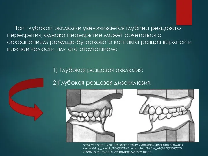 При глубокой окклюзии увеличивается глубина резцового перекрытия, однако перекрытие может