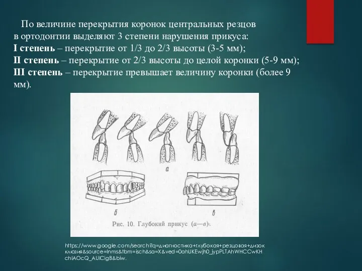 https://www.google.com/search?q=диагностика+глубокая+резцовая+дизокклюзия&source=lnms&tbm=isch&sa=X&ved=0ahUKEwjh0_jypPLTAhWHCCwKHchlAOcQ_AUICigB&biw. По величине перекрытия коронок центральных резцов в ортодонтии выделяют