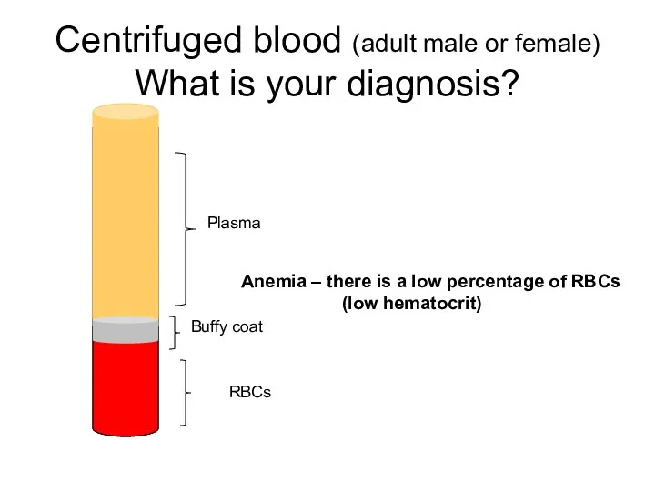 Centrifuged blood (adult male or female) What is your diagnosis? Anemia – there