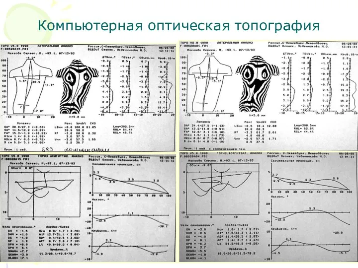 Компьютерная оптическая топография