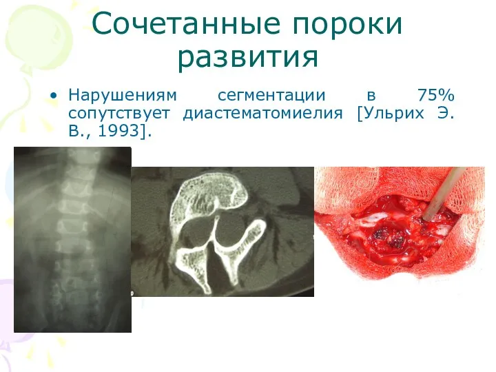 Сочетанные пороки развития Нарушениям сегментации в 75% сопутствует диастематомиелия [Ульрих Э.В., 1993].