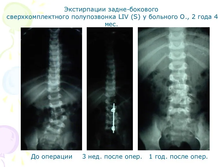 Экстирпации задне-бокового сверхкомплектного полупозвонка LIV (S) у больного О., 2