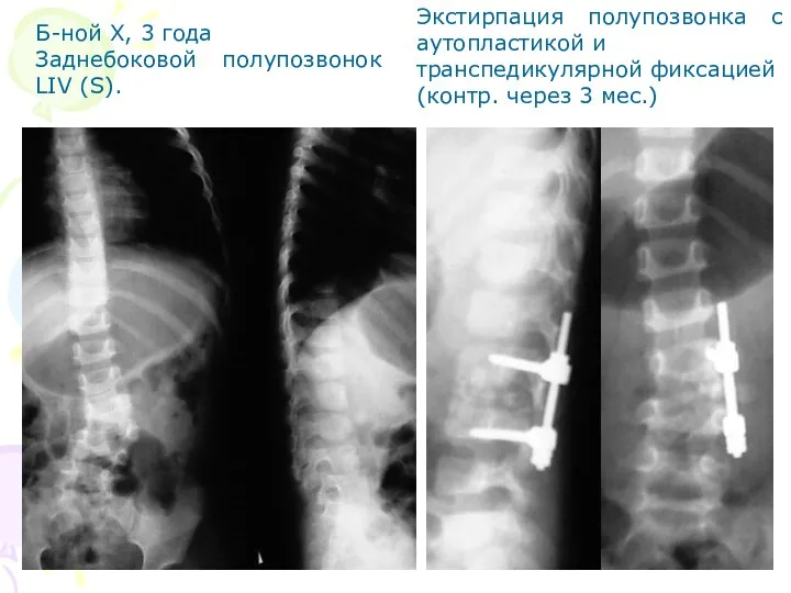 Экстирпация полупозвонка с аутопластикой и транспедикулярной фиксацией (контр. через 3