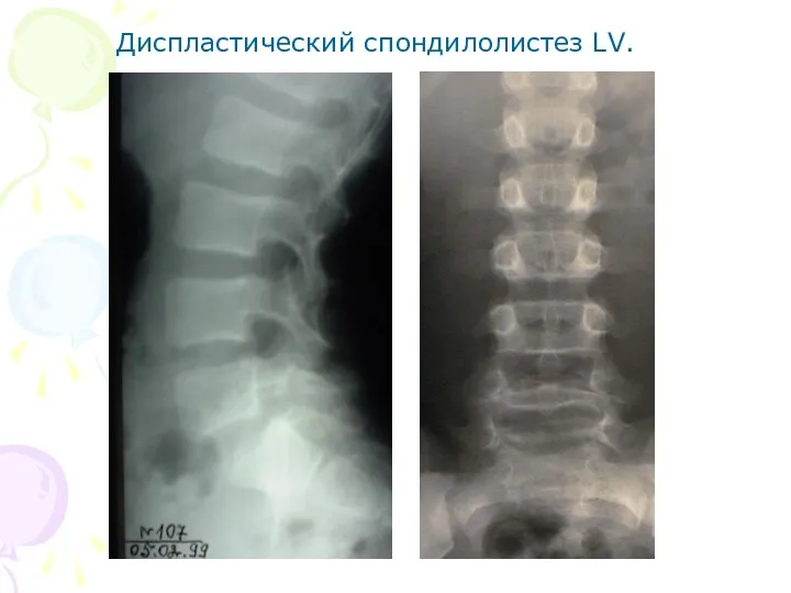 Диспластический спондилолистез LV.