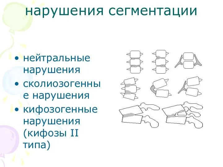 нарушения сегментации нейтральные нарушения сколиозогенные нарушения кифозогенные нарушения (кифозы II типа)