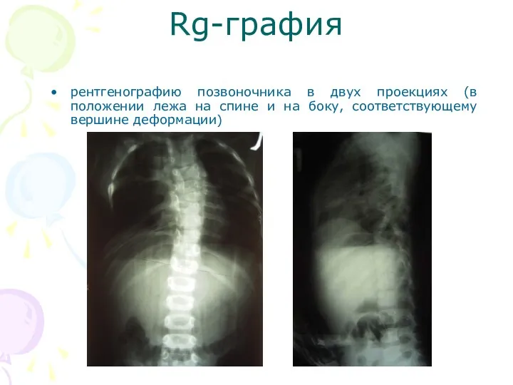 рентгенографию позвоночника в двух проекциях (в положении лежа на спине