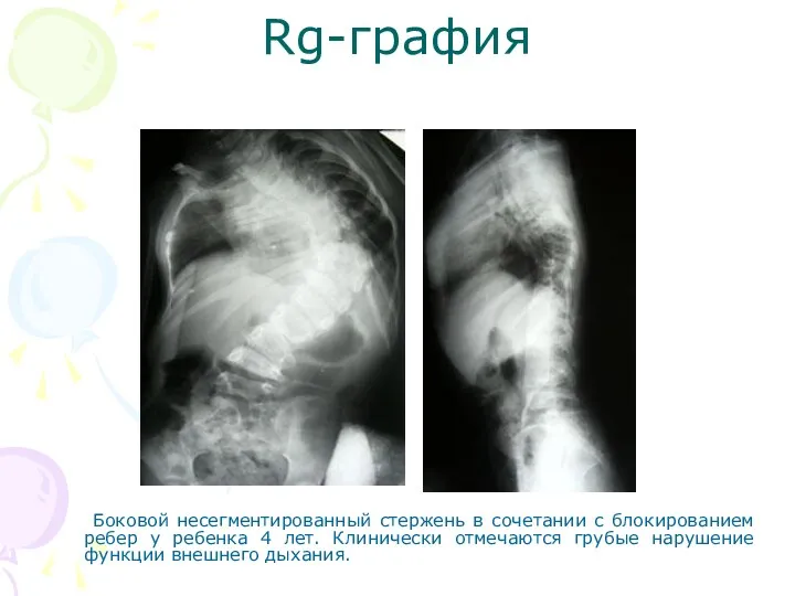 Rg-графия Боковой несегментированный стержень в сочетании с блокированием ребер у