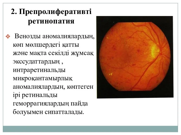 2. Препролиферативті ретинопатия Венозды аномалиялардың, көп мөлшердегі қатты және мақта секілді жұмсақ экссудаттардың
