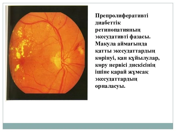 Препролиферативті диабеттік ретинопатияның экссудативті фазасы. Макула аймағында қатты экссудаттардың көрінуі, қан құйылулар, көру